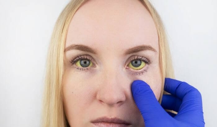 Olho amarelado no canto