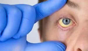 olhos amarelados