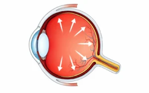 Glaucoma