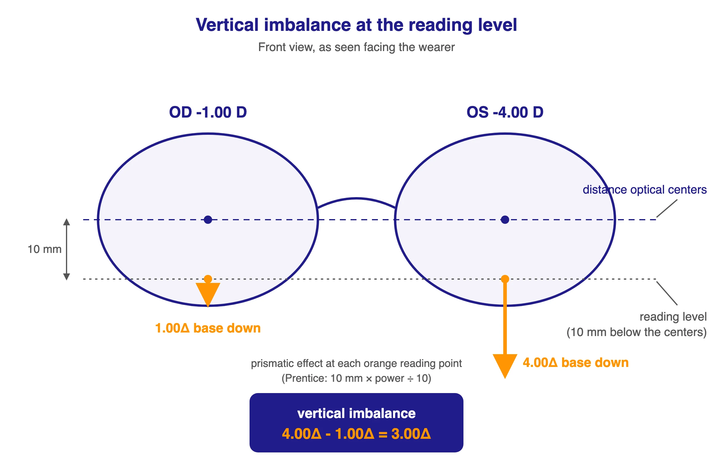 Diagram of vertical prism imbalance at the reading level: OD -1.00 D induces 1.00 prism diopter base down and OS -4.00 D induces 4.00 prism diopters base down at a reading point 10 mm below the optical centers, leaving a 3.00 prism diopter vertical imbalance